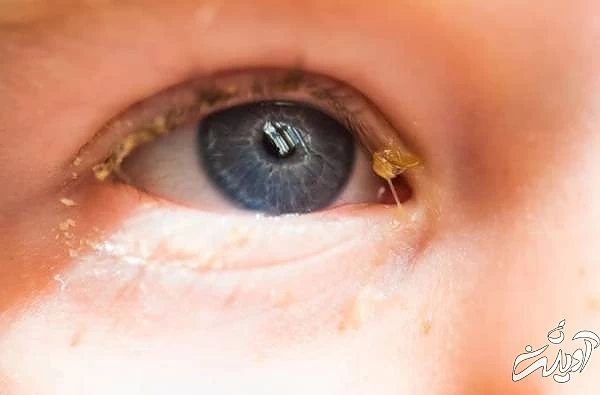 ترشحات داخل چشم ترشحات چشم